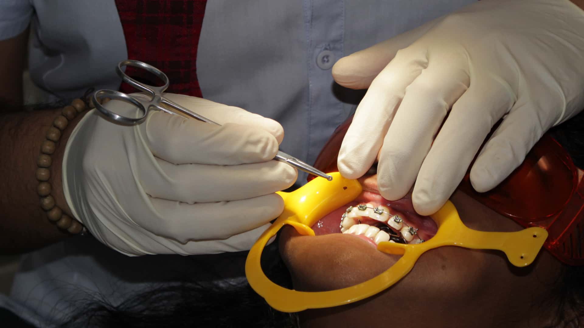 Orthodontie Vestibulaire – Bague et brackets